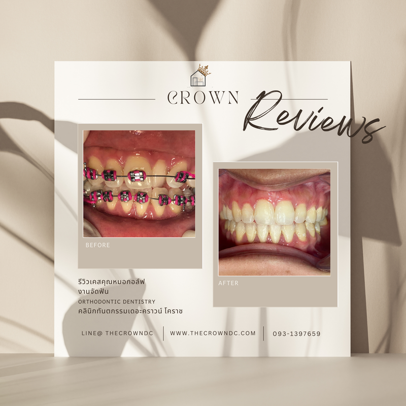 รีวิวการรักษาเคสจัดฟัน(บางส่วน)