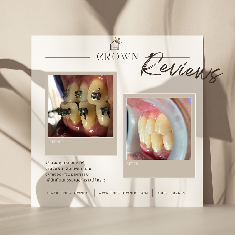 รีวิวการรักษาเคสจัดฟัน(บางส่วน)