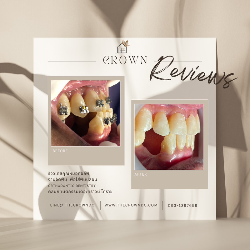 รีวิวการรักษาเคสจัดฟัน(บางส่วน)