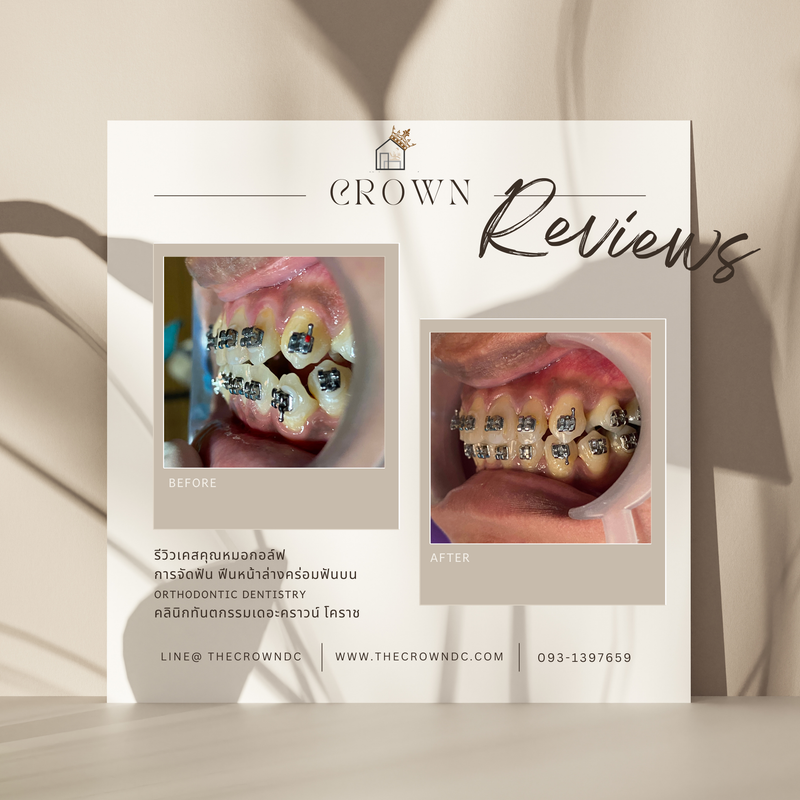 รีวิวการรักษาเคสจัดฟัน(บางส่วน)