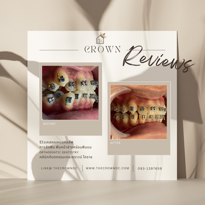 รีวิวการรักษาเคสจัดฟัน(บางส่วน)