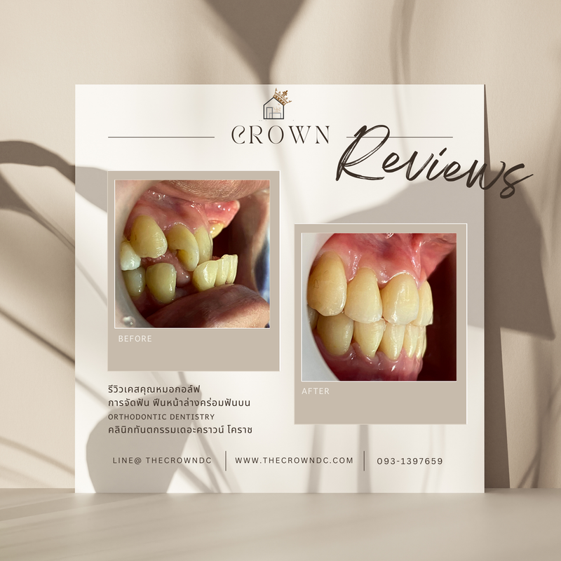 รีวิวการรักษาเคสจัดฟัน(บางส่วน)
