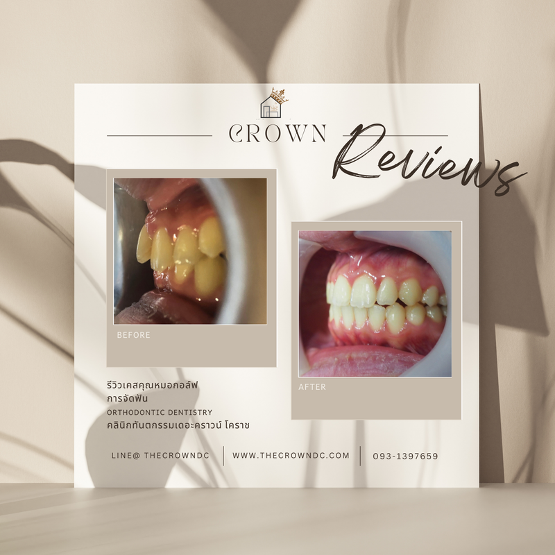 รีวิวการรักษาเคสจัดฟัน(บางส่วน)