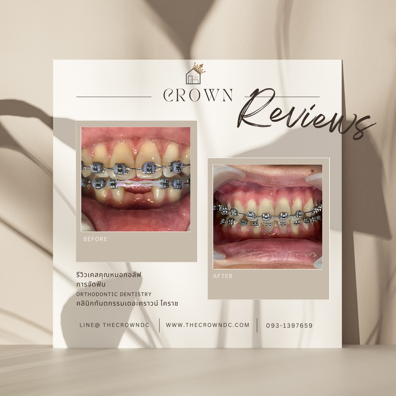 รีวิวการรักษาเคสจัดฟัน(บางส่วน)