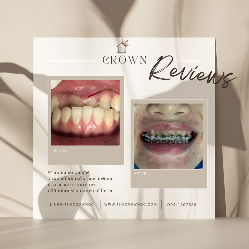 รีวิวการรักษาเคสจัดฟัน(บางส่วน)
