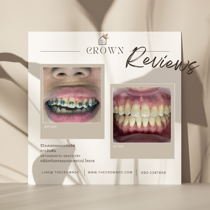 รีวิวการรักษาเคสจัดฟัน(บางส่วน)