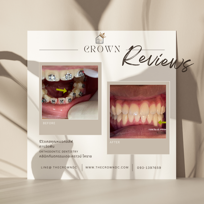 รีวิวการรักษาเคสจัดฟัน(บางส่วน)