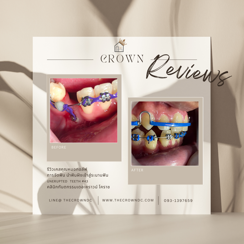 รีวิวการรักษาเคสจัดฟัน(บางส่วน)
