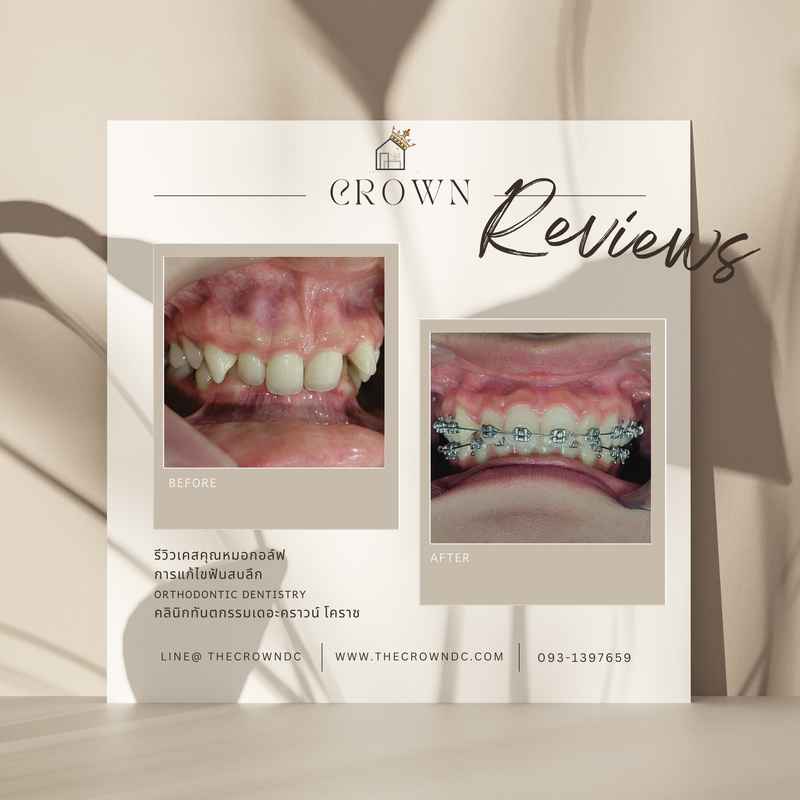 รีวิวการรักษาเคสจัดฟัน(บางส่วน)