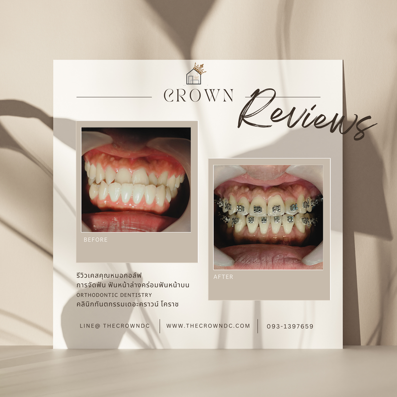 รีวิวการรักษาเคสจัดฟัน(บางส่วน)