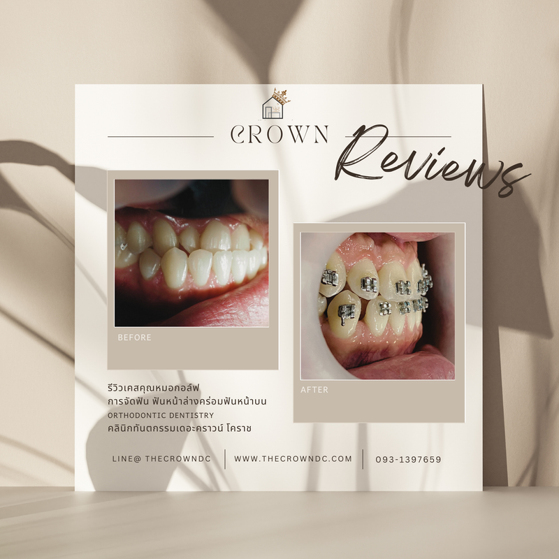 รีวิวการรักษาเคสจัดฟัน(บางส่วน)