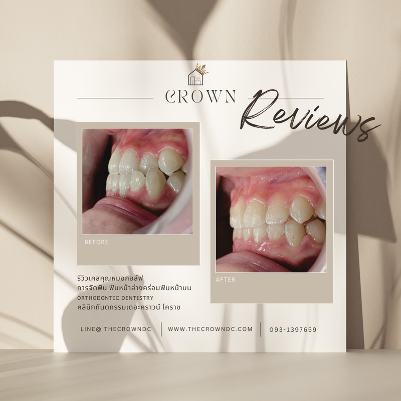 รีวิวการรักษาเคสจัดฟัน(บางส่วน)