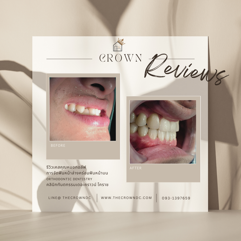 รีวิวการรักษาเคสจัดฟัน(บางส่วน)