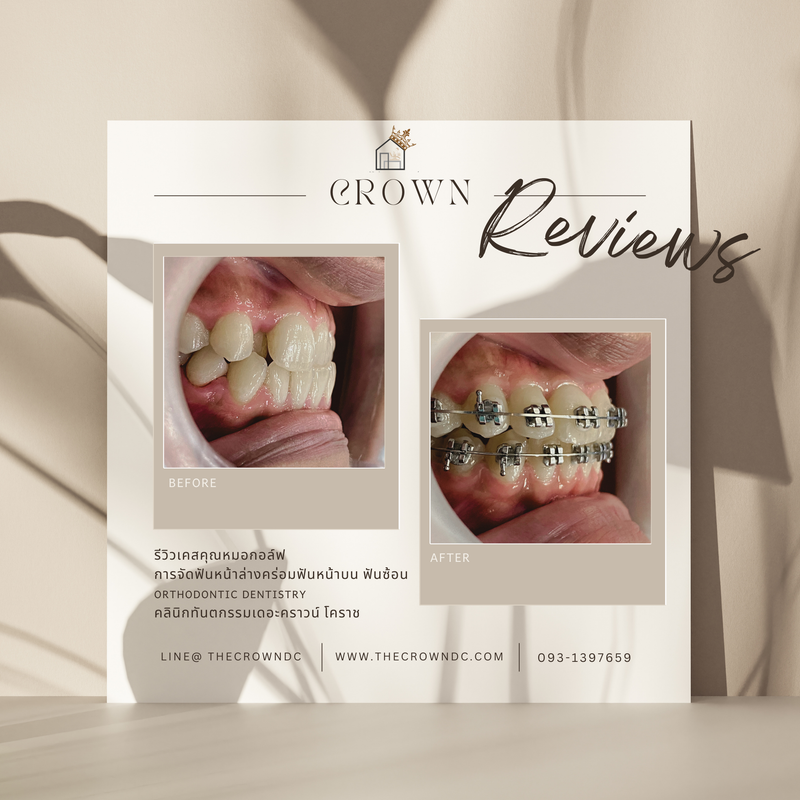 รีวิวการรักษาเคสจัดฟัน(บางส่วน)