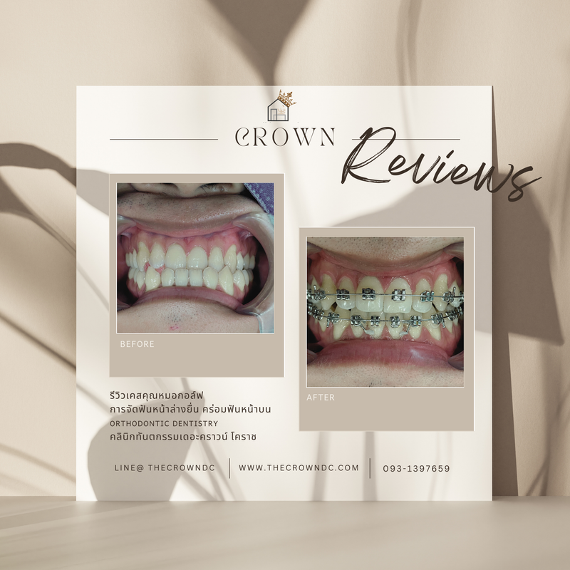 รีวิวการรักษาเคสจัดฟัน(บางส่วน)