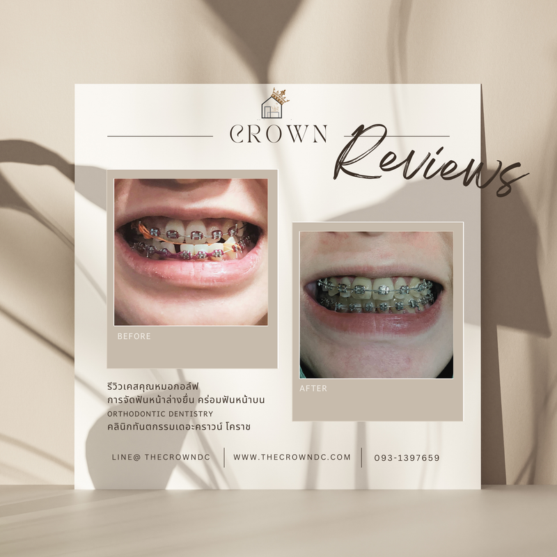 รีวิวการรักษาเคสจัดฟัน(บางส่วน)