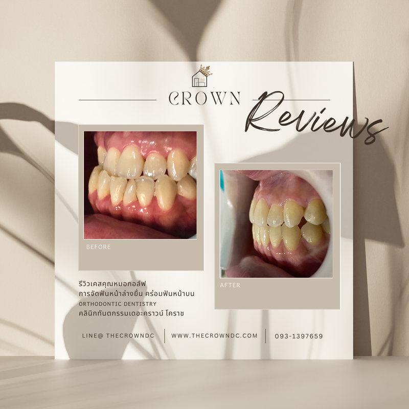 รีวิวการรักษาเคสจัดฟัน(บางส่วน)