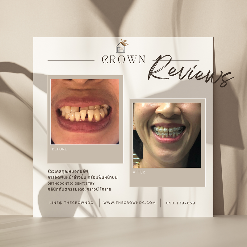 รีวิวการรักษาเคสจัดฟัน(บางส่วน)