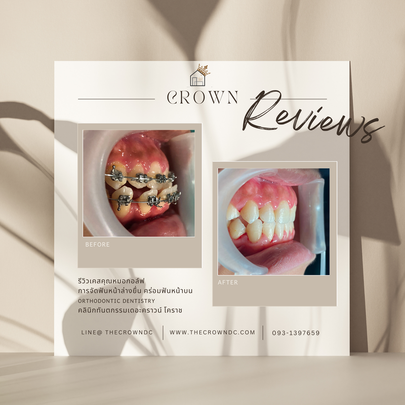 รีวิวการรักษาเคสจัดฟัน(บางส่วน)