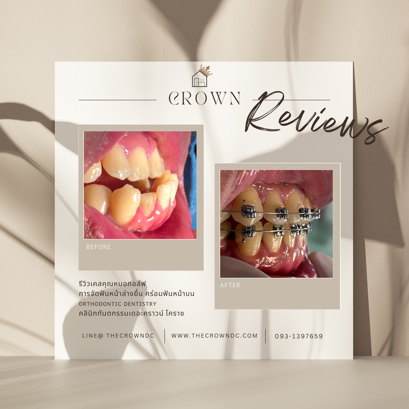 รีวิวการรักษาเคสจัดฟัน(บางส่วน)