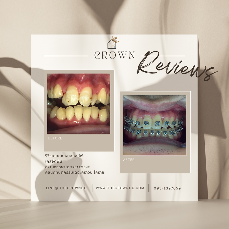 รีวิวการรักษาเคสจัดฟัน(บางส่วน)