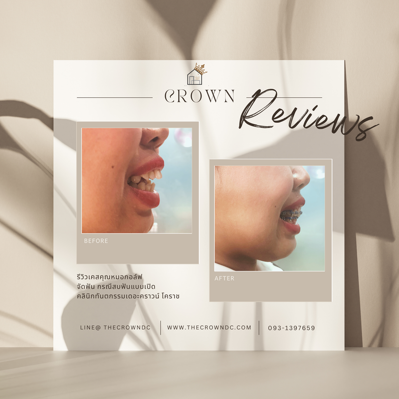 รีวิวการรักษาเคสจัดฟัน(บางส่วน)