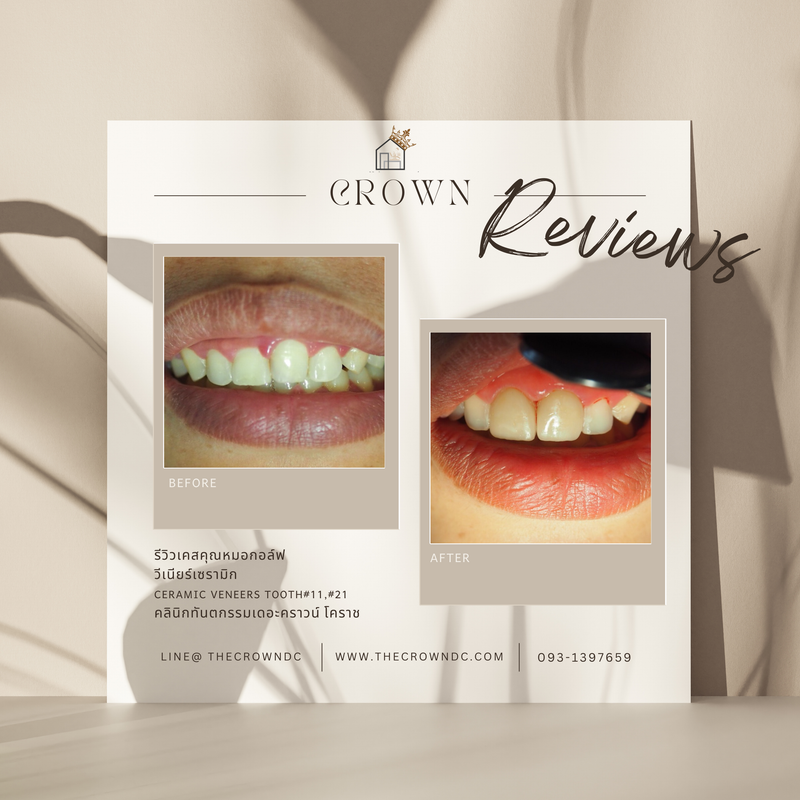 Ceramic veneers | เซรามิกวีเนียร์