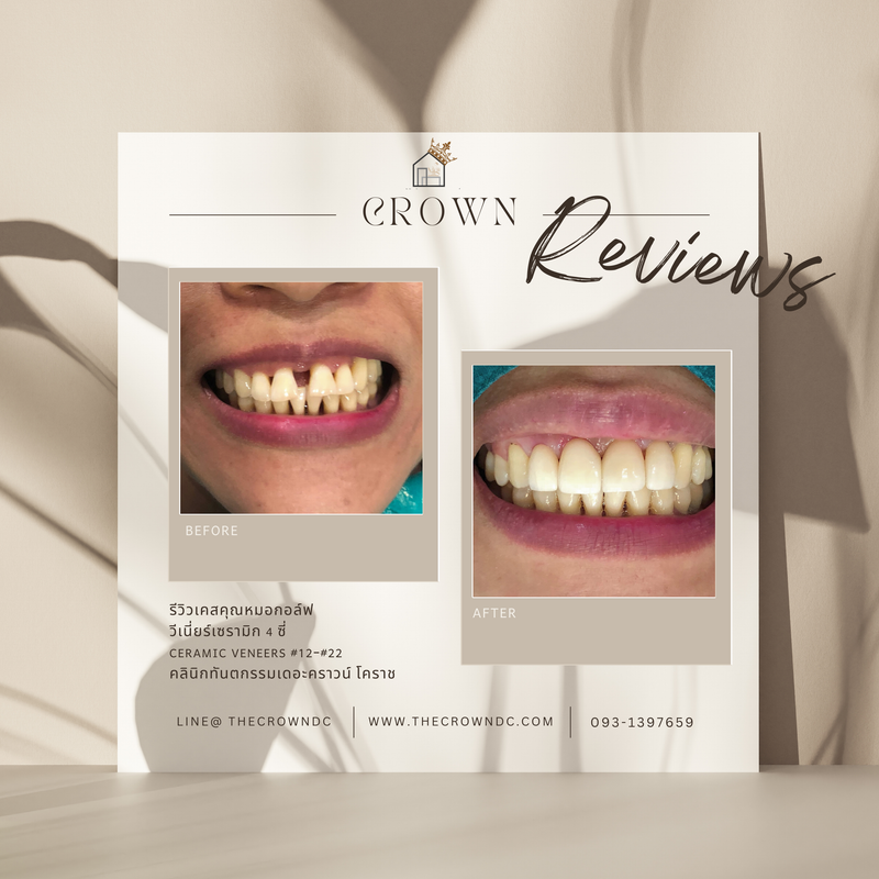 Ceramic veneers | เซรามิกวีเนียร์