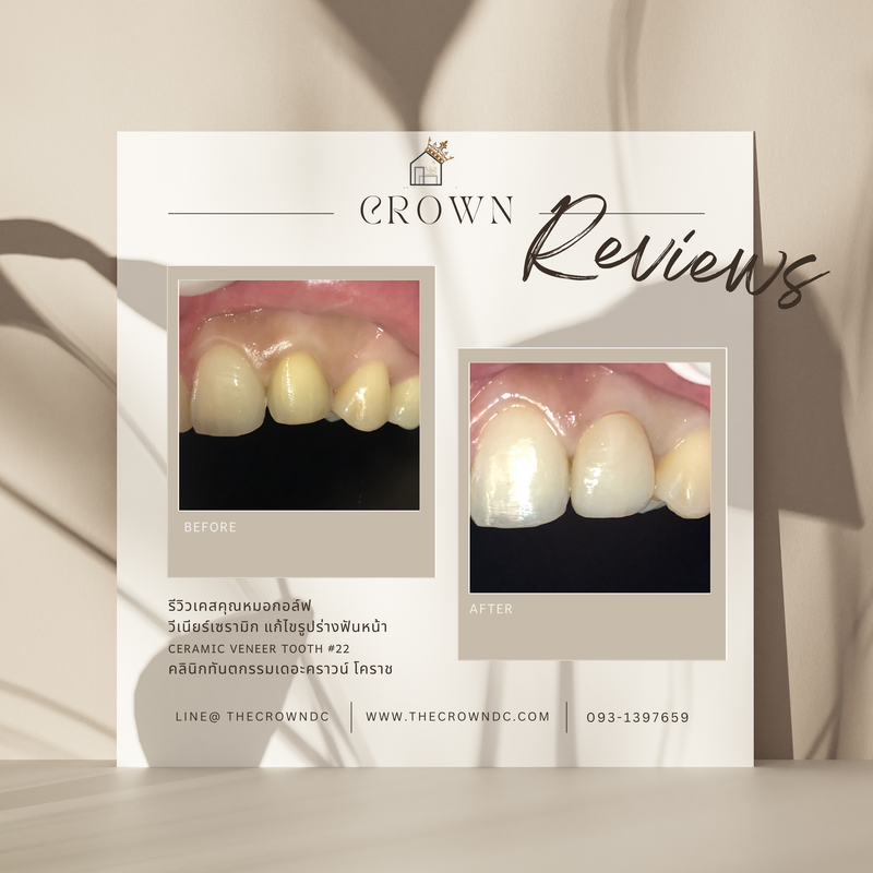 Ceramic veneers | เซรามิกวีเนียร์