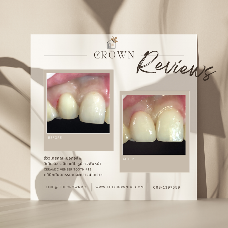 Ceramic veneers | เซรามิกวีเนียร์