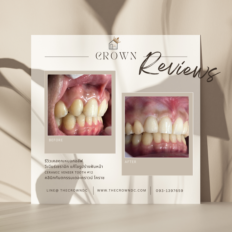 Ceramic veneers | เซรามิกวีเนียร์
