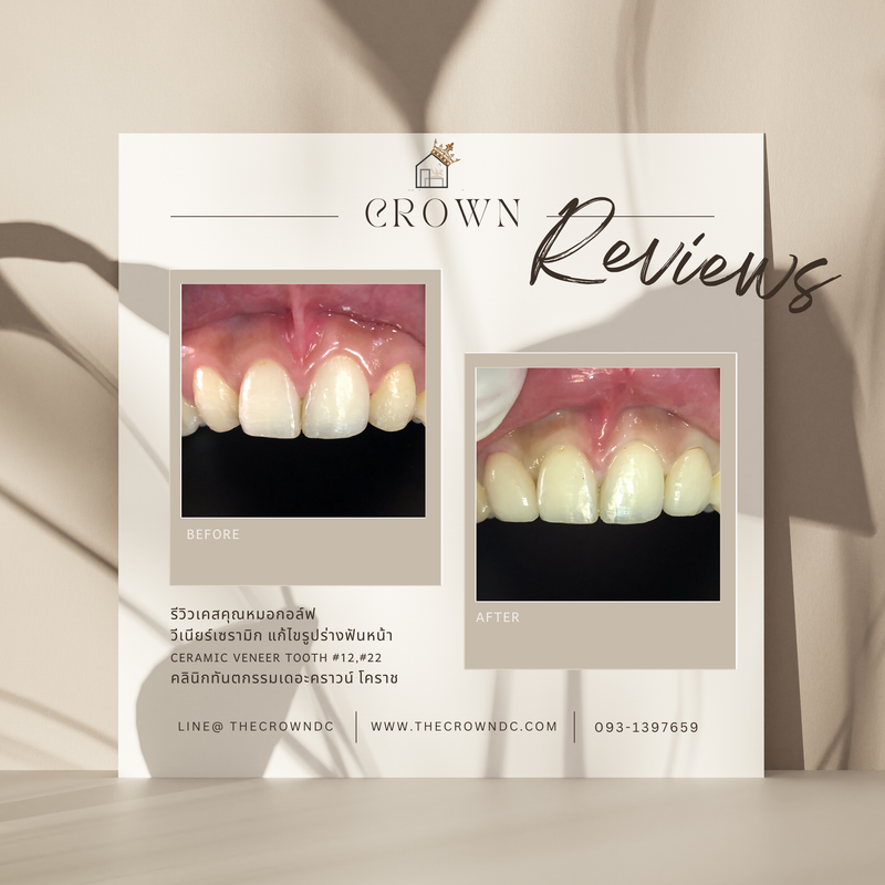 Ceramic veneers | เซรามิกวีเนียร์