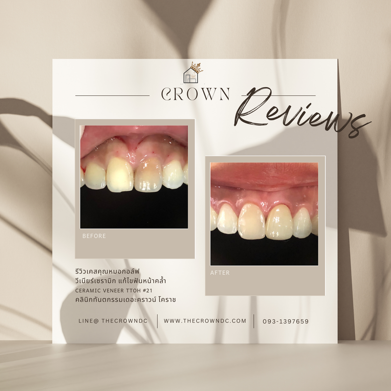 Ceramic veneers | เซรามิกวีเนียร์