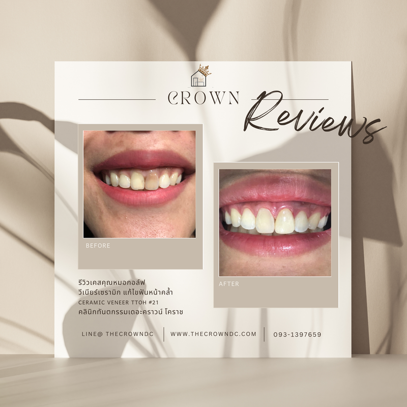 Ceramic veneers | เซรามิกวีเนียร์