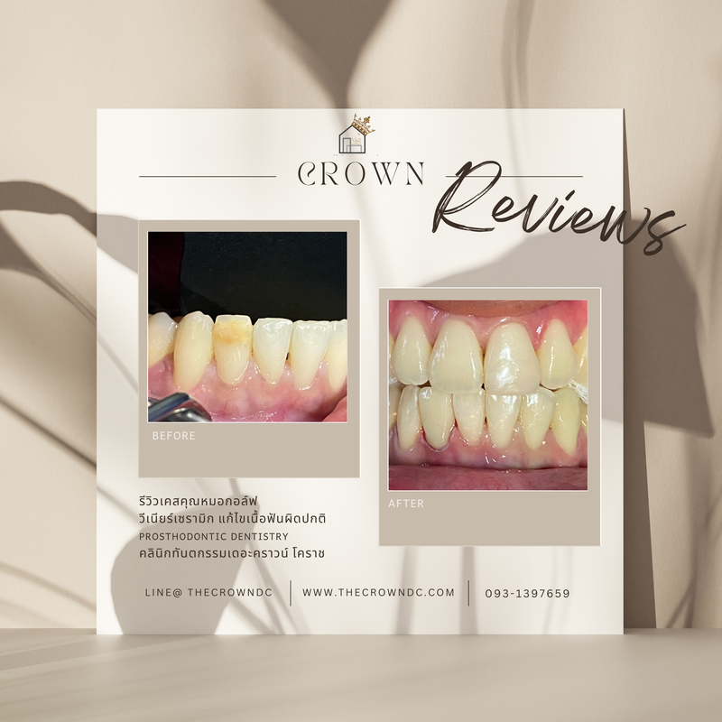 Ceramic veneers | เซรามิกวีเนียร์