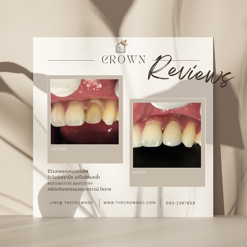 Ceramic veneers | เซรามิกวีเนียร์
