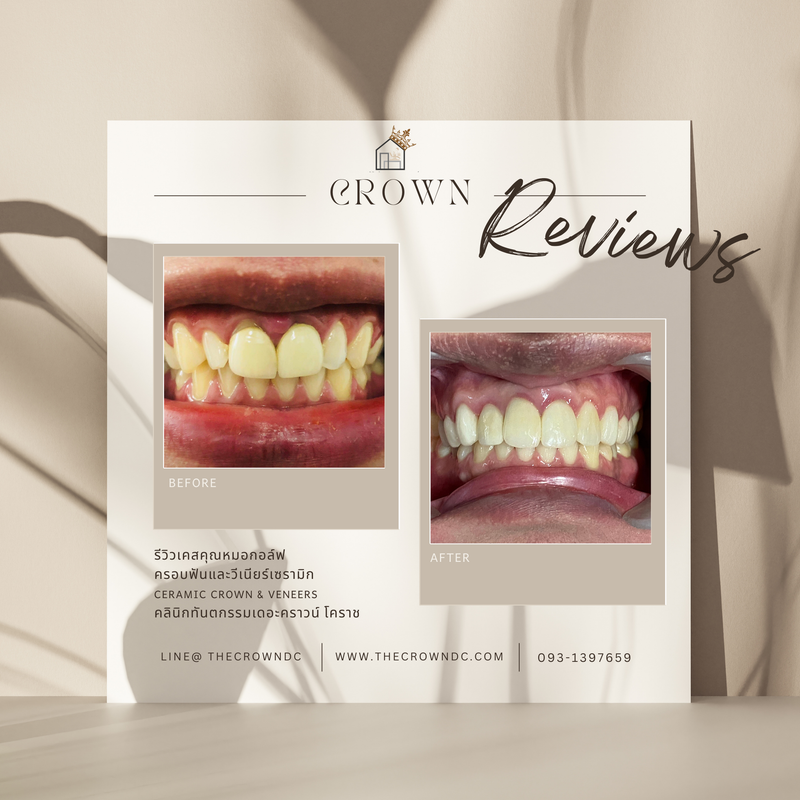 Ceramic veneers | เซรามิกวีเนียร์