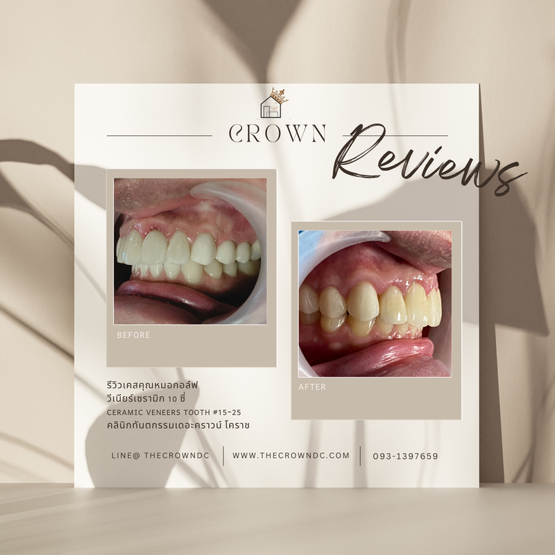 Ceramic veneers | เซรามิกวีเนียร์
