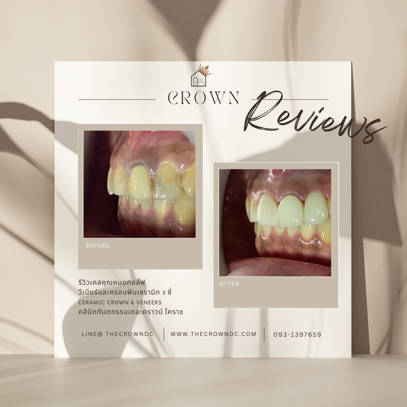 Ceramic veneers | เซรามิกวีเนียร์