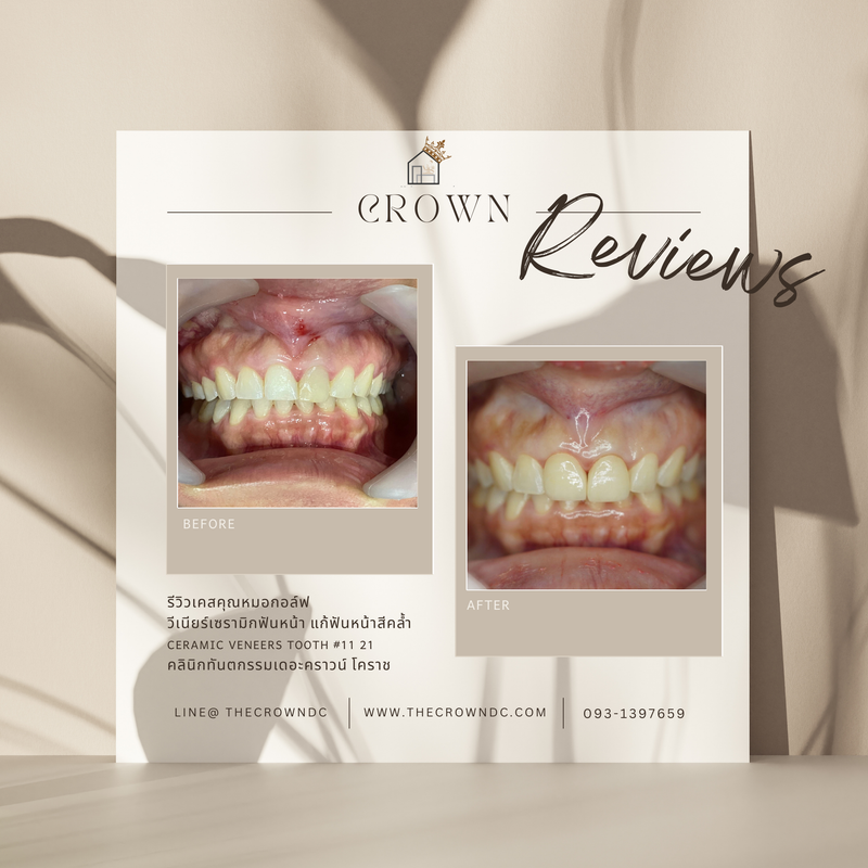 Ceramic veneers | เซรามิกวีเนียร์