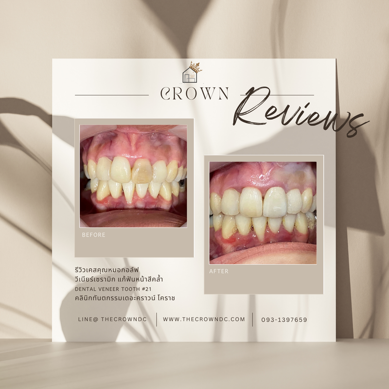 Ceramic veneers | เซรามิกวีเนียร์