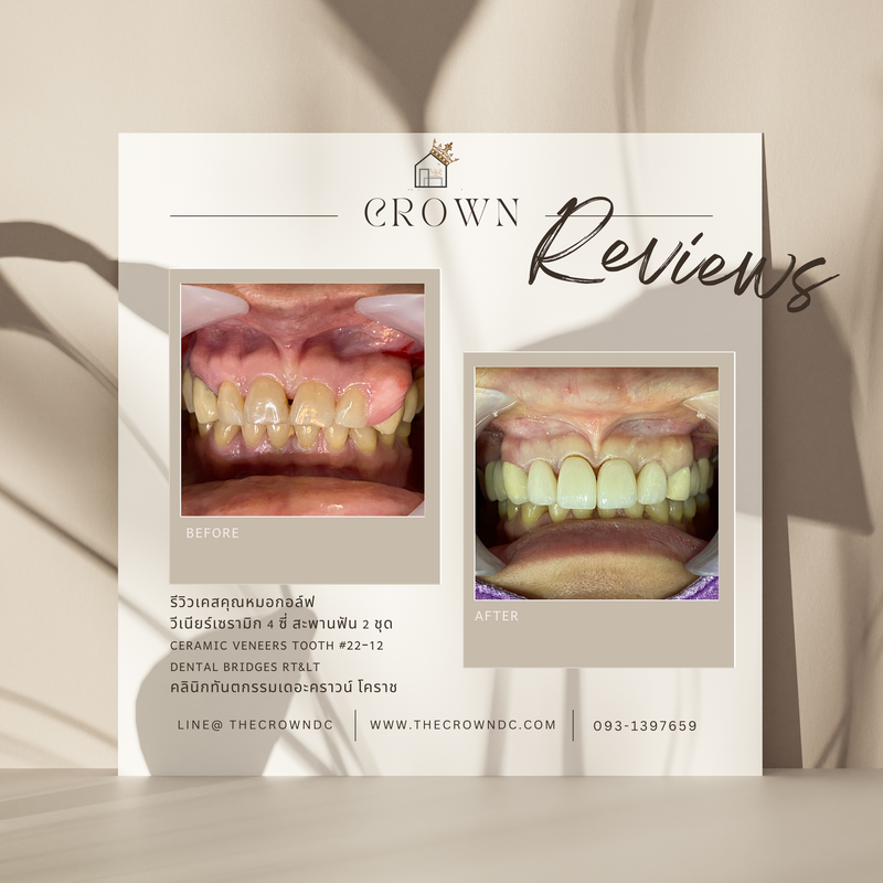 Ceramic veneers | เซรามิกวีเนียร์