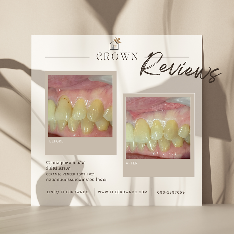 Ceramic veneers | เซรามิกวีเนียร์