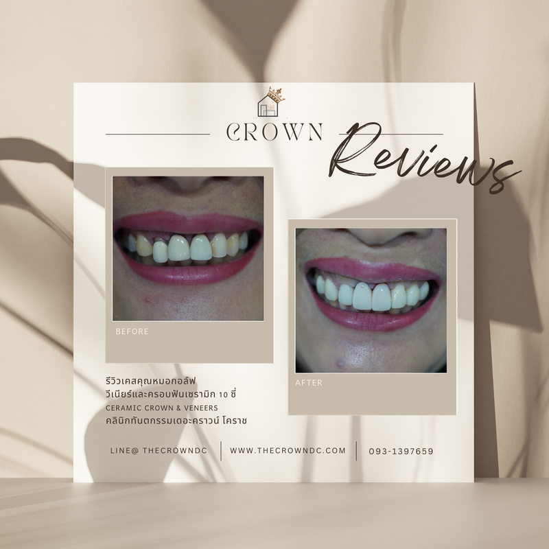Ceramic veneers | เซรามิกวีเนียร์