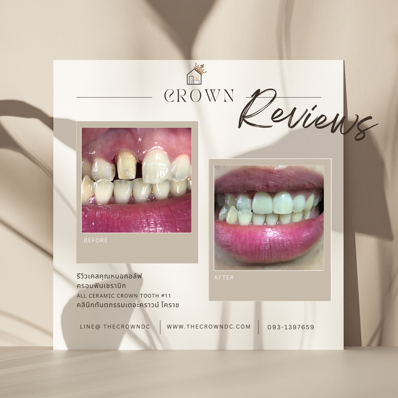 Ceramic crown | ครอบฟันเซรามิก
