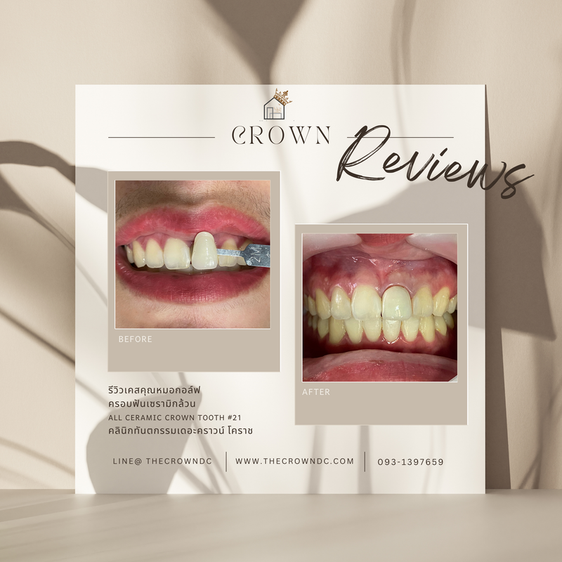 Ceramic crown | ครอบฟันเซรามิก