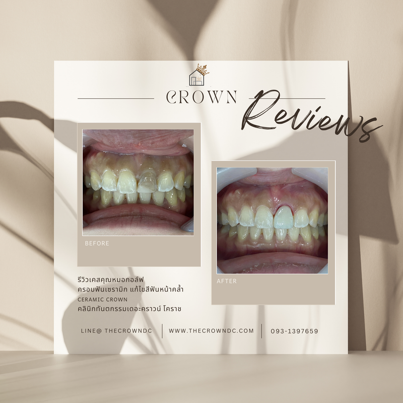 Ceramic crown | ครอบฟันเซรามิก