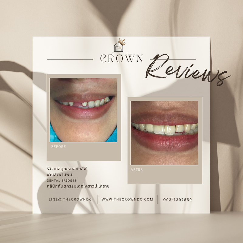 Ceramic crown | ครอบฟันเซรามิก