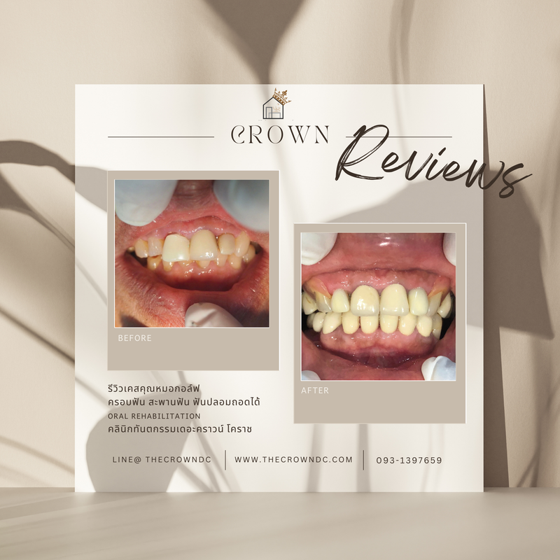 Ceramic crown | ครอบฟันเซรามิก