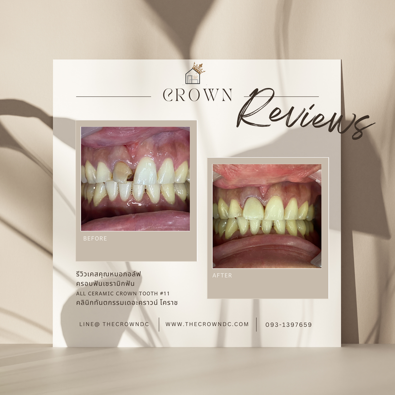 Ceramic crown | ครอบฟันเซรามิก